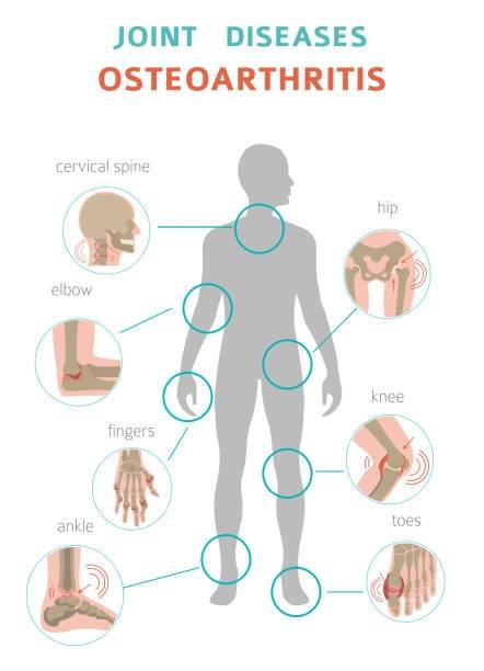 Arthritis, osteoarthritis medical infographic design. Joint replacement, implantant. Vector illustration